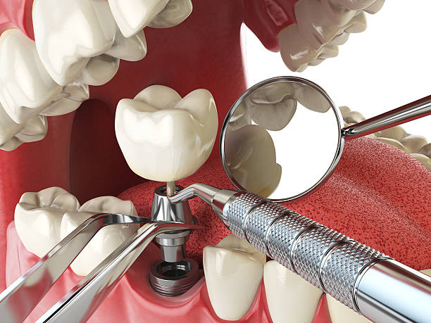 Best Emergency Dental Extractions in Lexico, CA